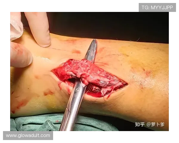 小卢卡斯右腿跟腱断裂手术成功